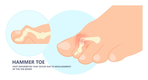 Hammer Toe Correction
