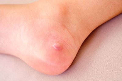 Managing Foot Blisters