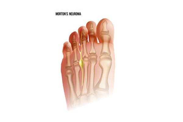 Symptoms And Causes Of Morton’s Neuroma