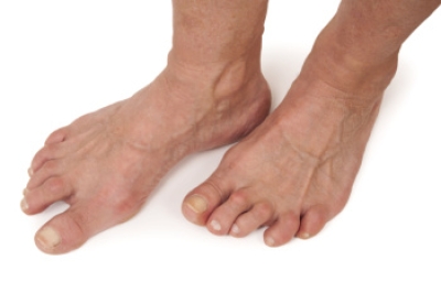 Symptoms of Rheumatoid Arthritis in the Feet